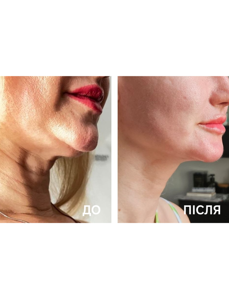 rf ліфтинг обличчя