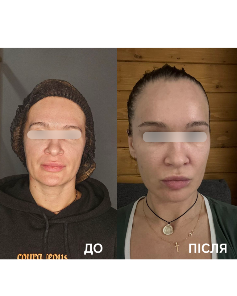 3d омолодження обличчя